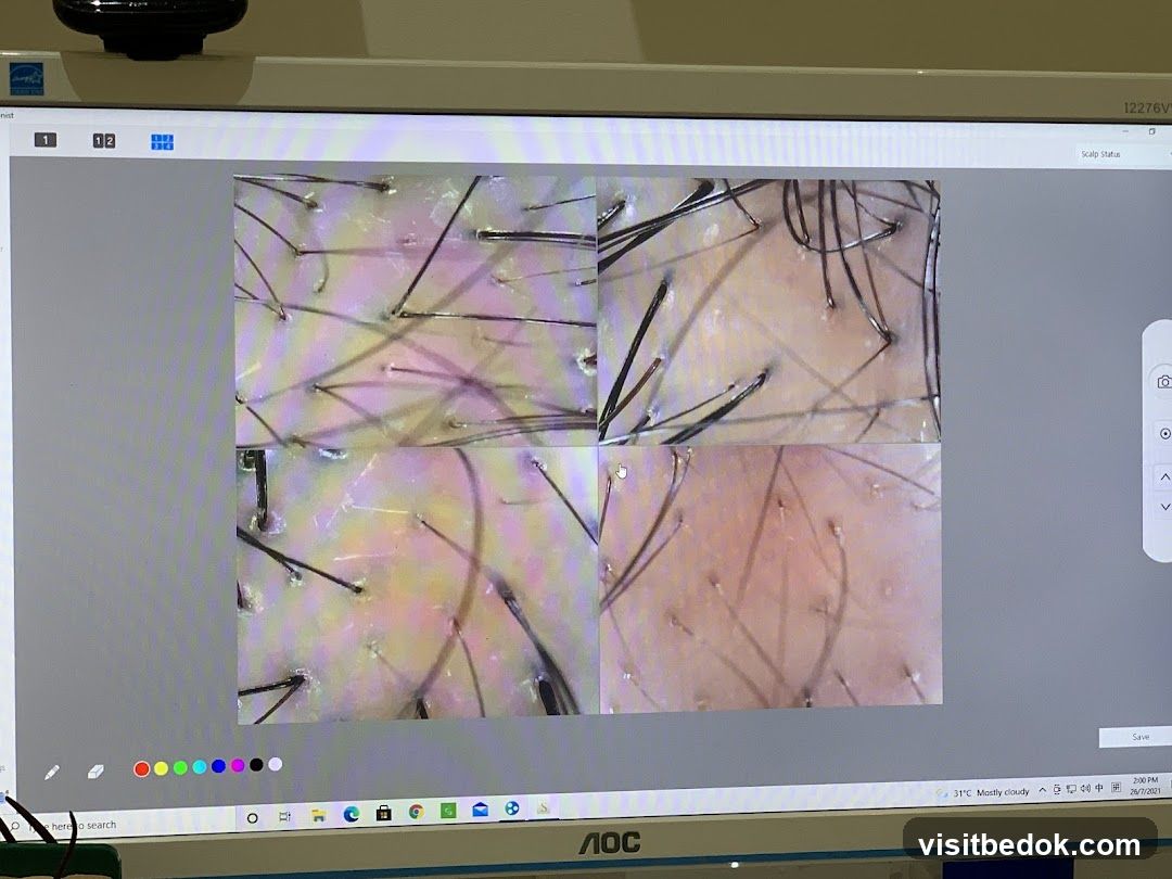 Scalp Analysis Screen