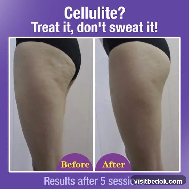 Cellulite treatment before and after
